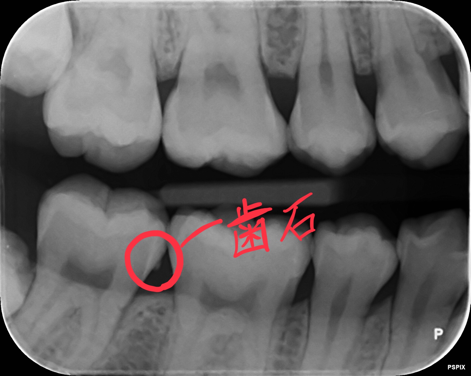 レントゲン写真で見る歯周治療とは？  稲沢市の歯医者｜稲沢のぐち 